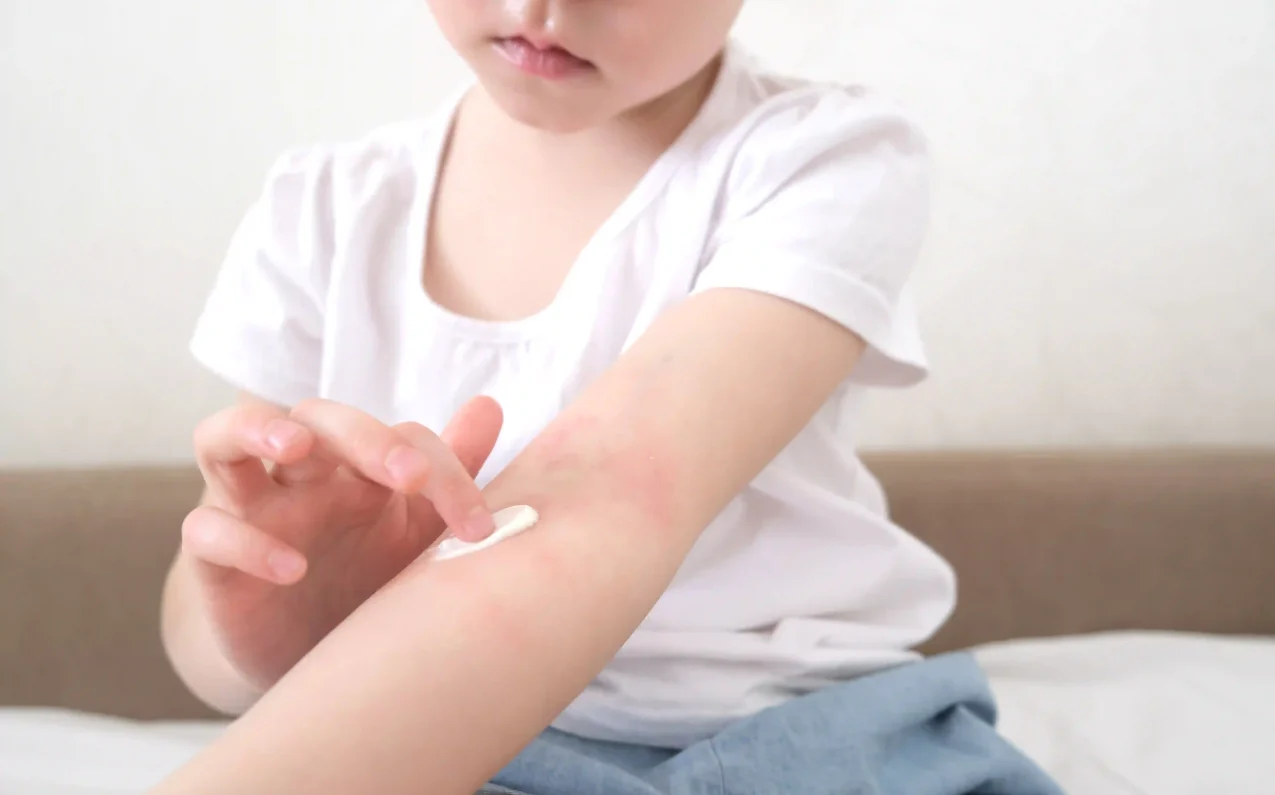 Ease 9 Eczema in Children Strategies for Joyful Days