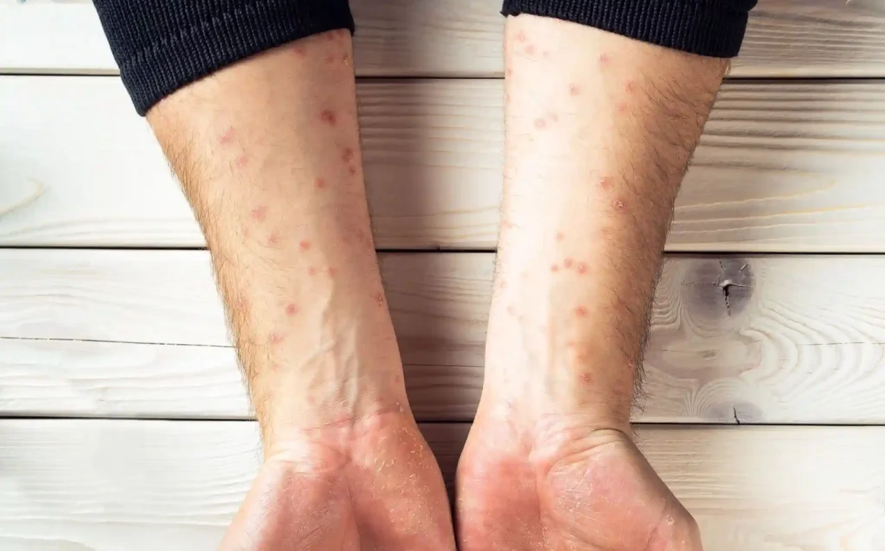 Causes of dermatitis