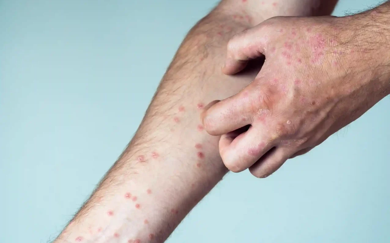 Allergic dermatitis causes